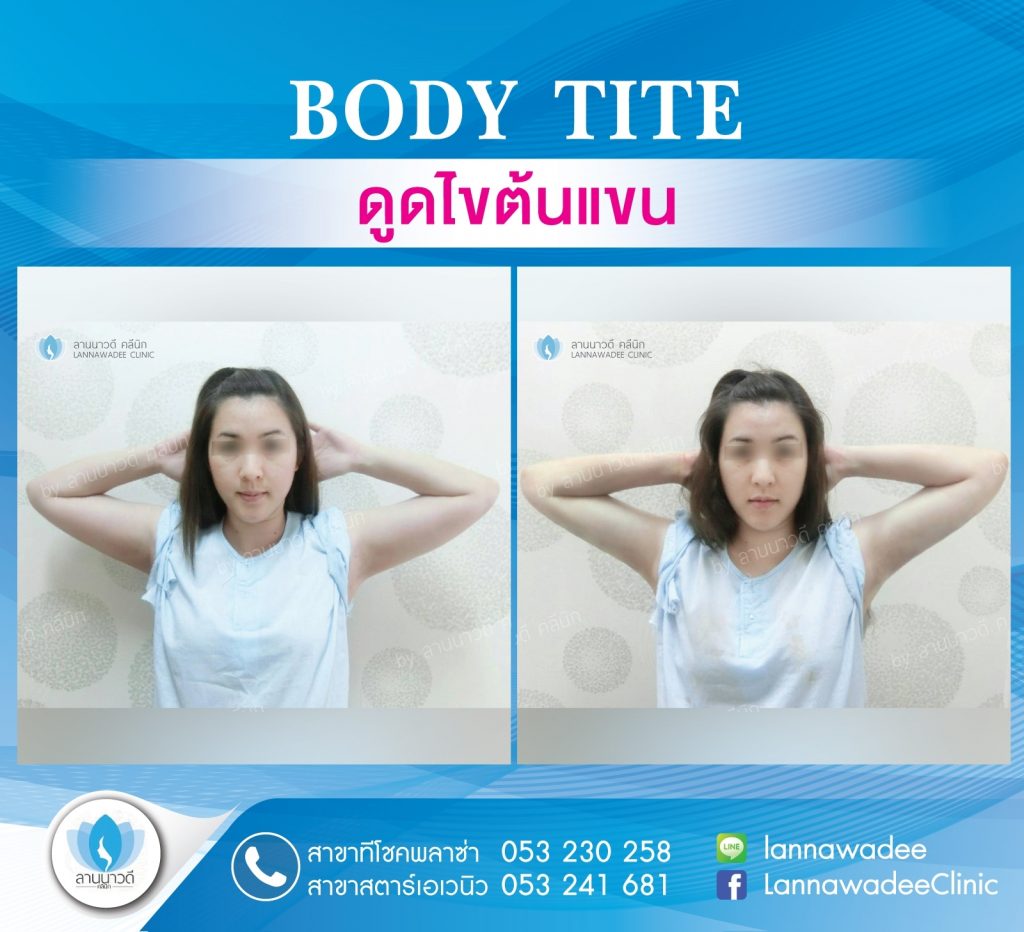 Liposuction Chiang Mai