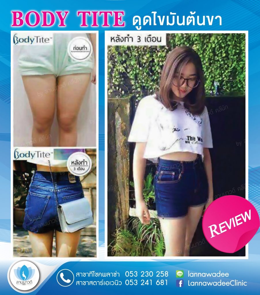 Liposuction Chiang Mai