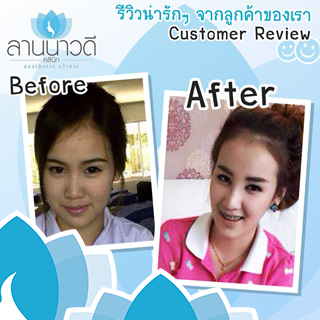 รีวิวเสริมจมูกเชียงใหม่