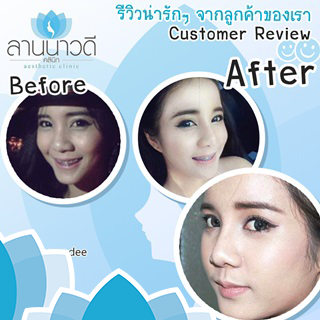 รีวิวเสริมจมูกลานนาวดีคลินิก