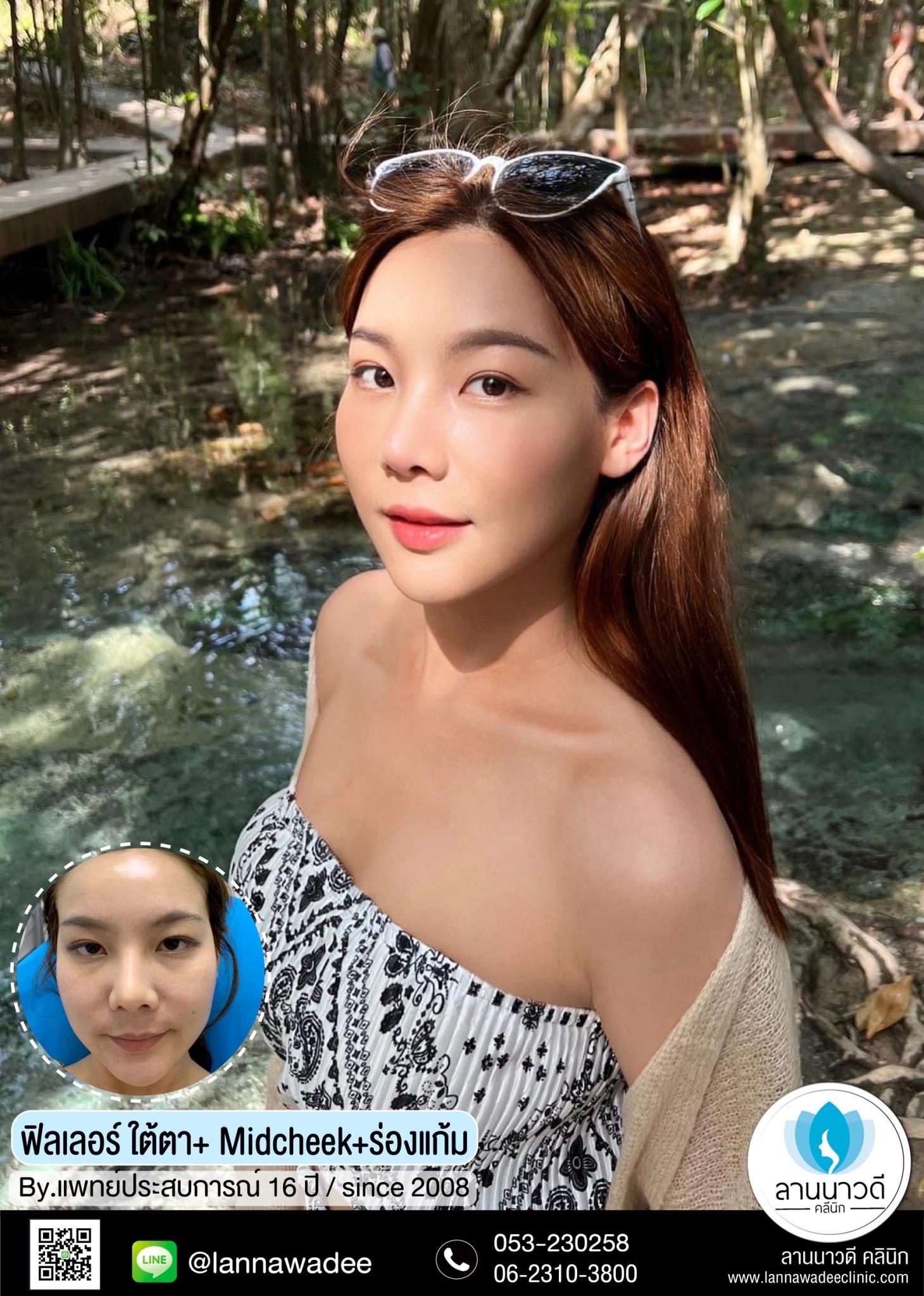 ฟิลเลอร์