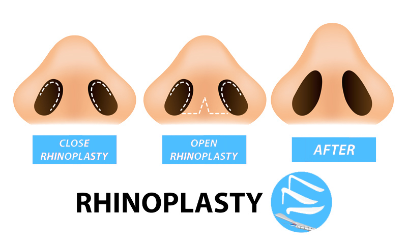 แก้จมูกแบบโอเพ่น (OPEN)