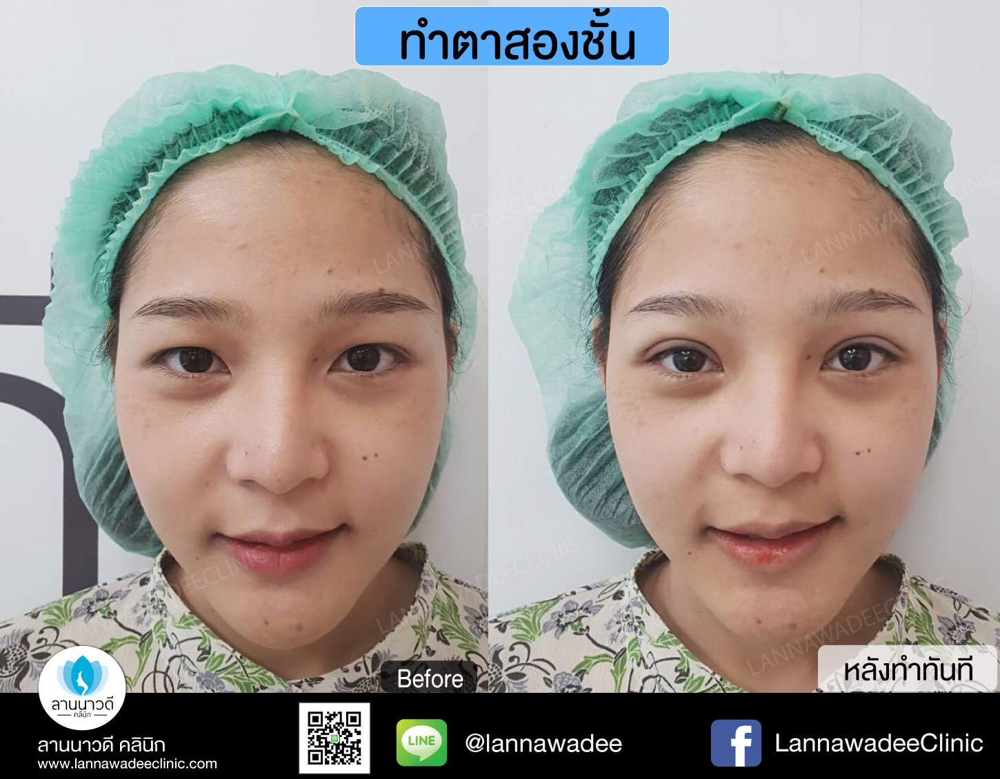 ทำตาสองชั้นที่ไหนดี รีวิว