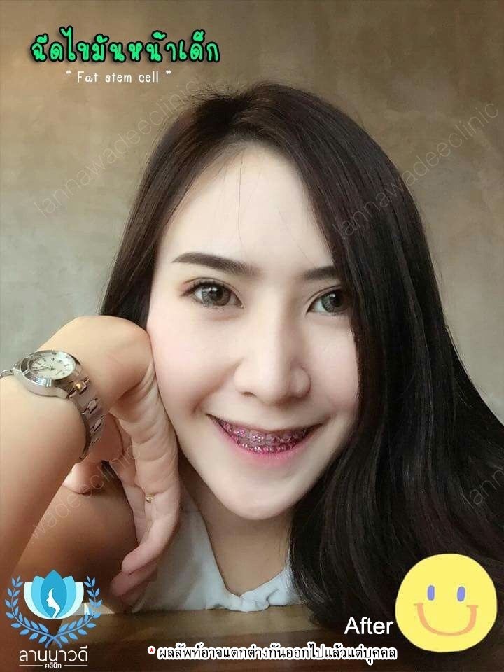 รีวิวฉีดไขมันหน้า