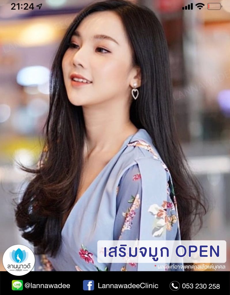 แก้จมูก open แพงไหม