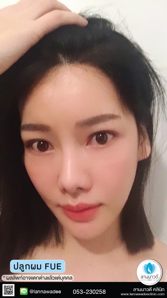ปลูกผม
