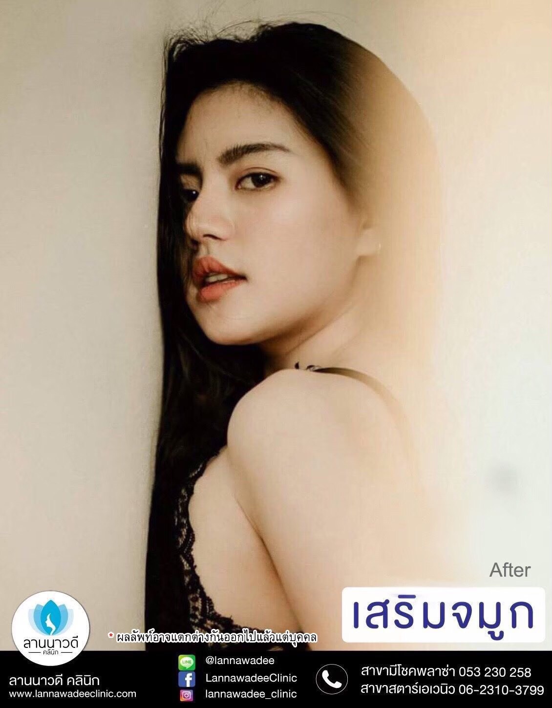 เสริมจมูกที่ไหนดี เชียงใหม่2566