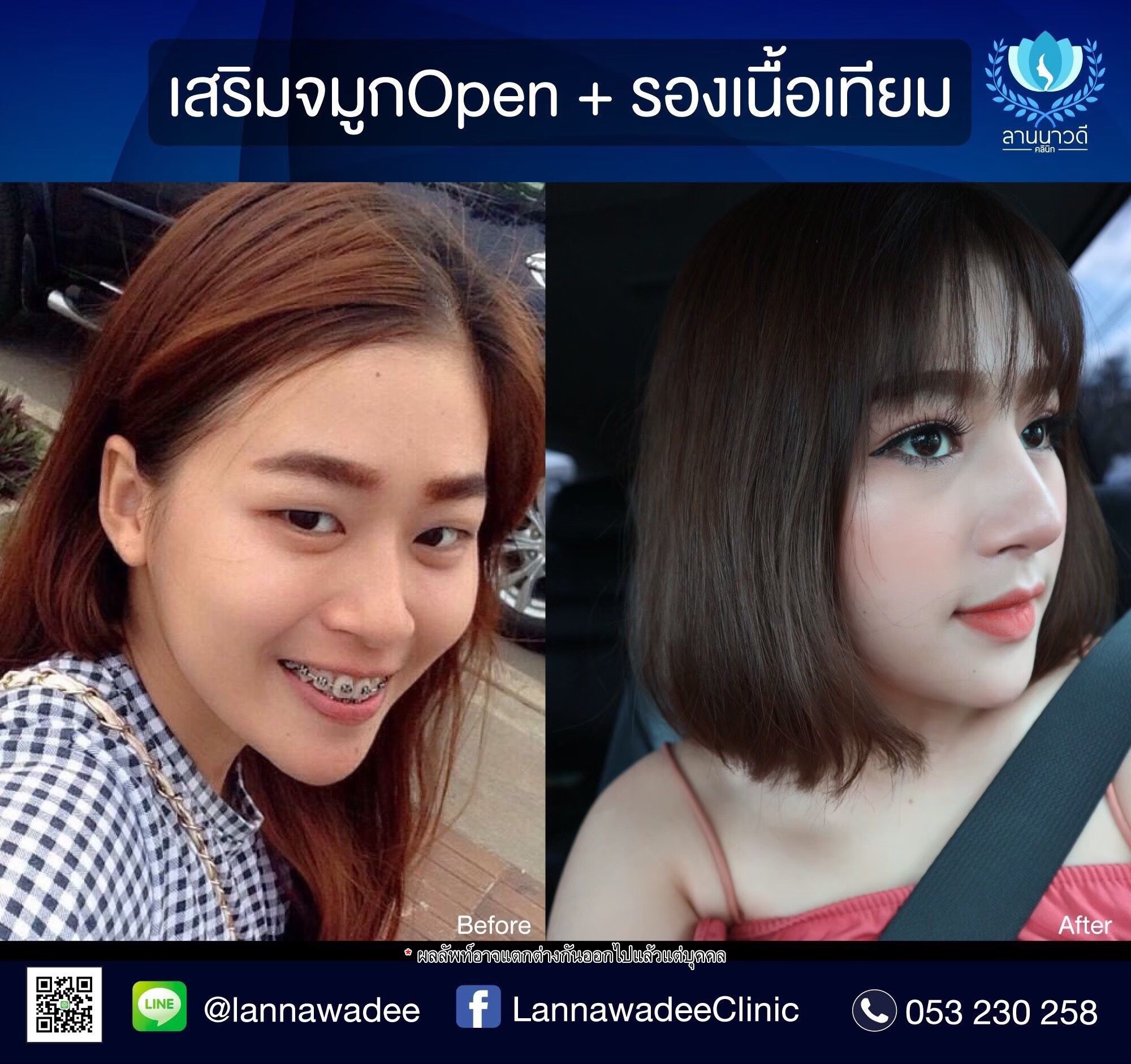 เสริมจมูกopen