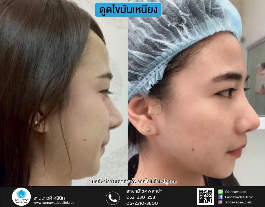 Liposuction Chiang Mai