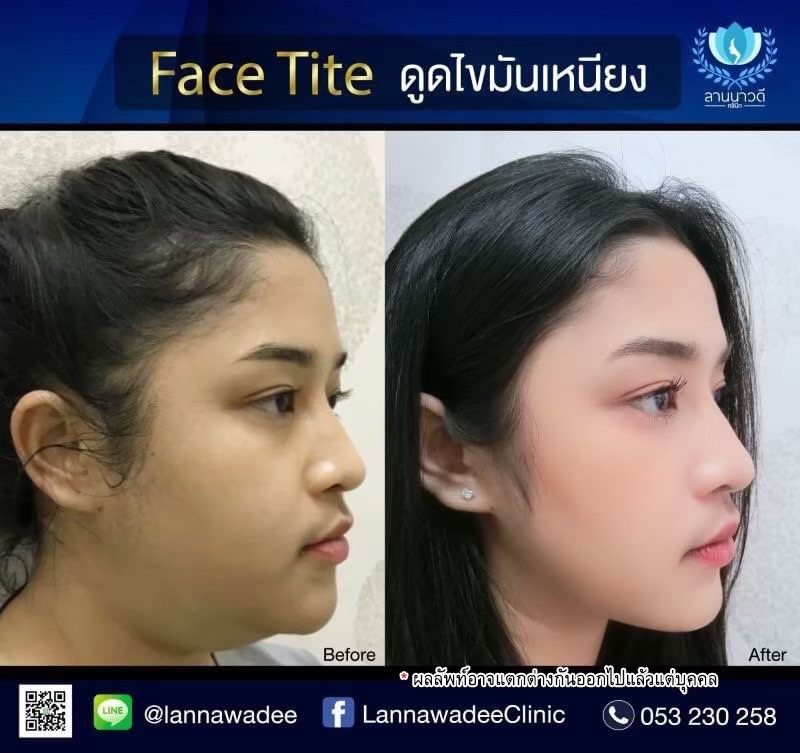 Liposuction Chiang Mai