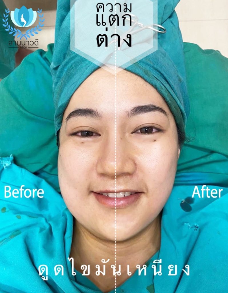 Liposuction Chiang Mai