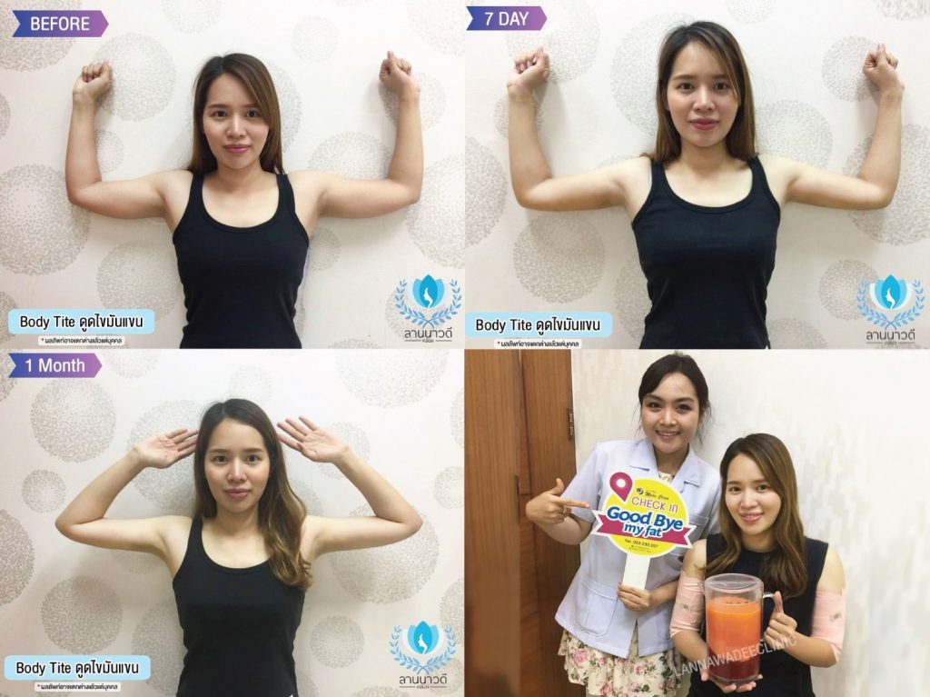 Liposuction Chiang Mai