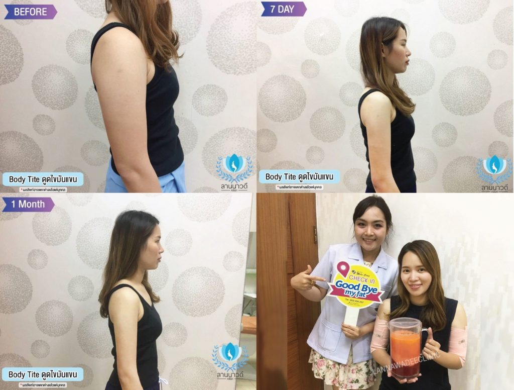 Liposuction Chiang Mai