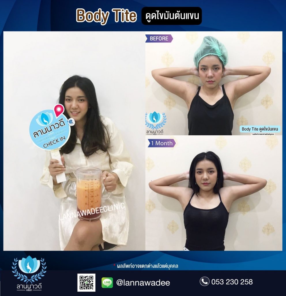 Liposuction Chiang Mai