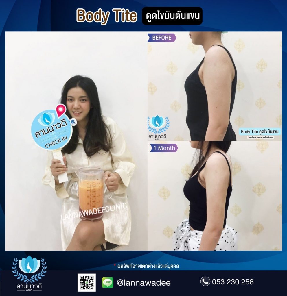 Liposuction Chiang Mai