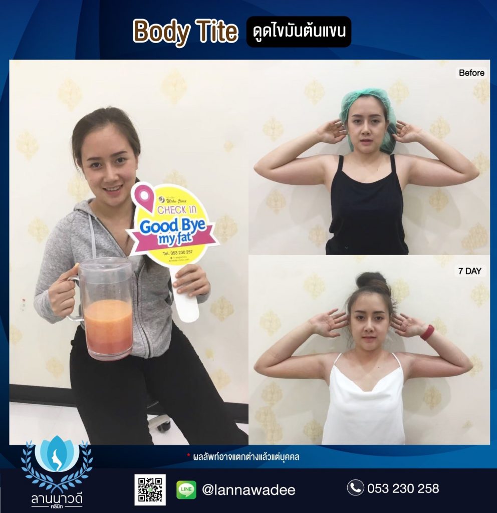 Liposuction Chiang Mai