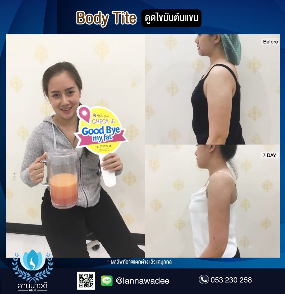 Liposuction Chiang Mai