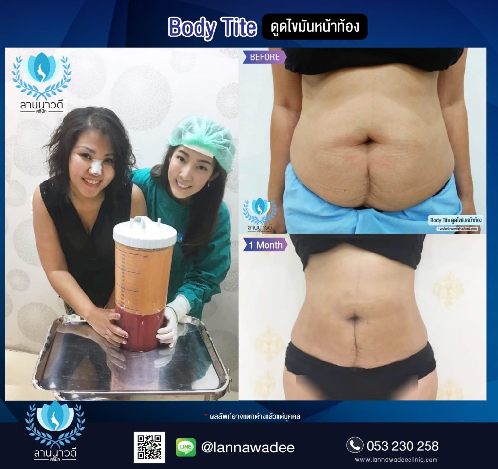 Liposuction Chiang Mai