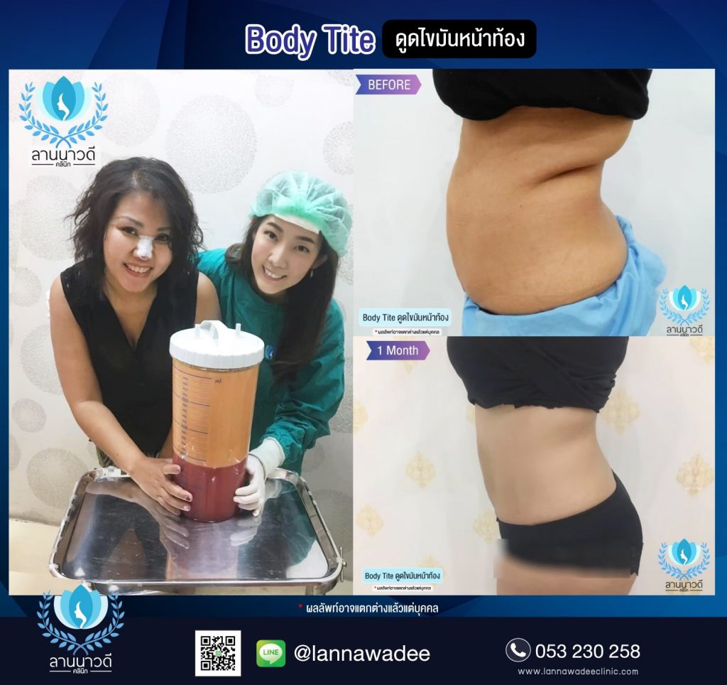 Liposuction Chiang Mai