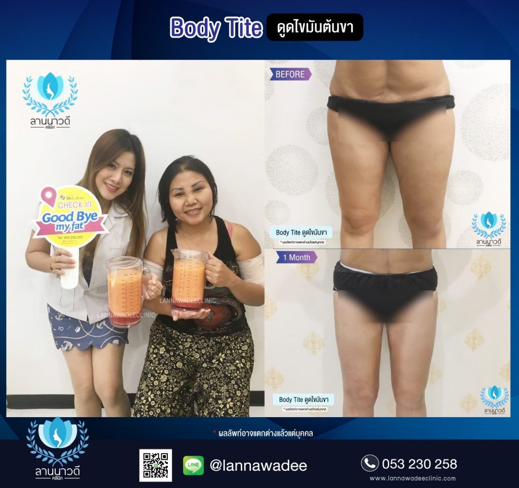 Liposuction Chiang Mai