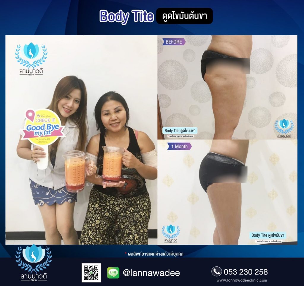 Liposuction Chiang Mai