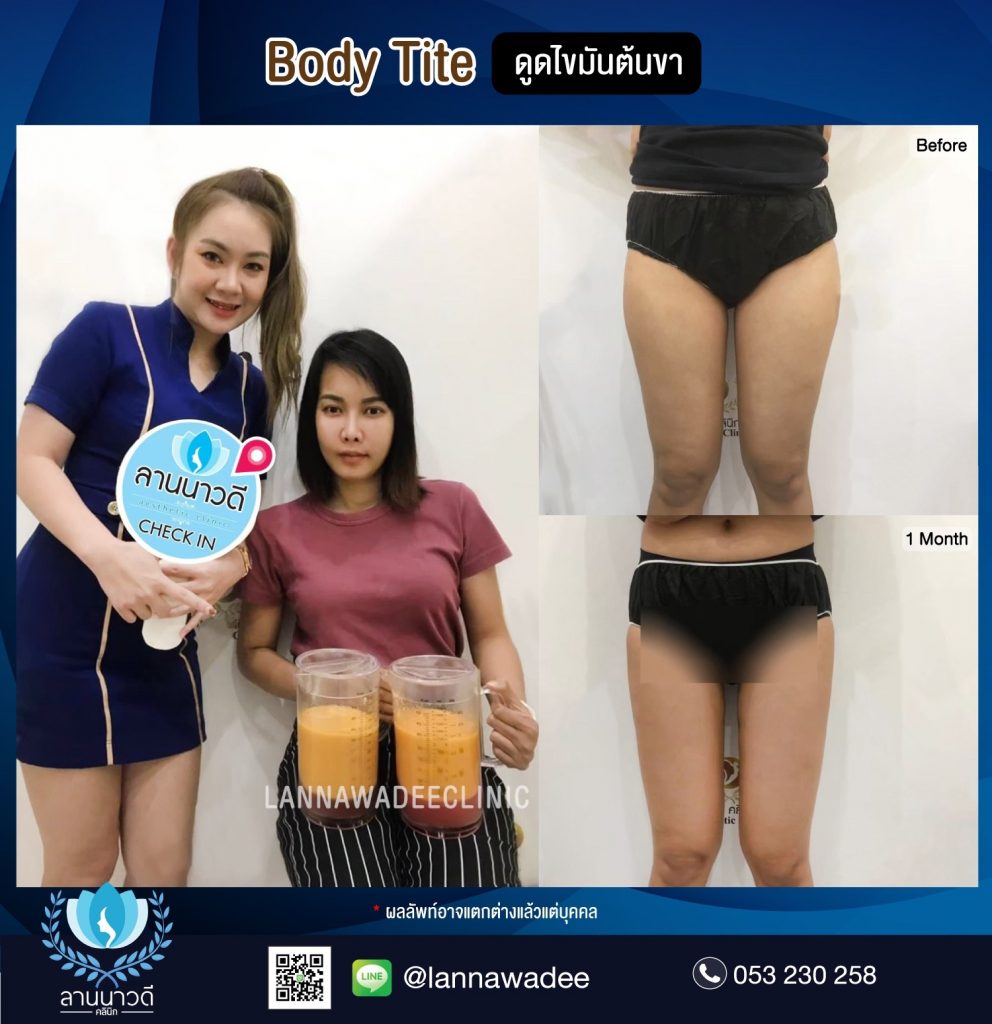 Liposuction Chiang Mai