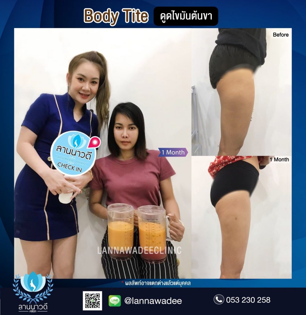 Liposuction Chiang Mai