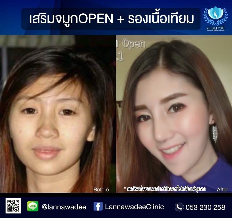 แก้จมูก open เชียงใหม่