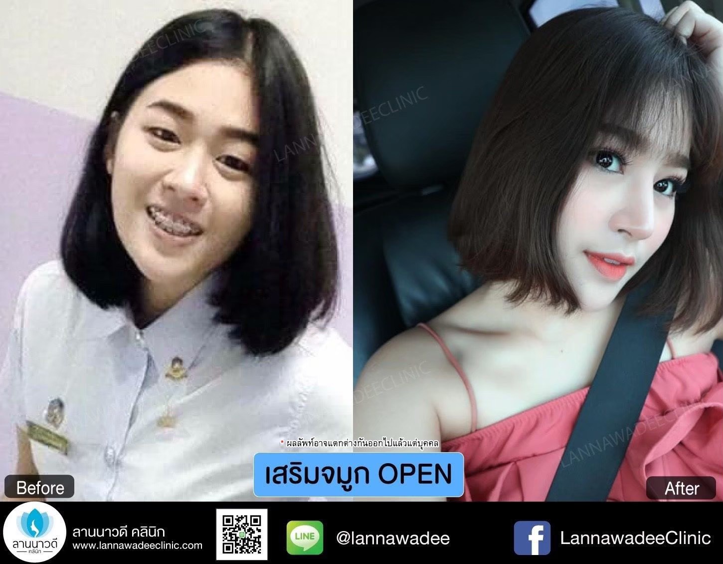 รีวิวเสริมจมูกเชียงใหม่