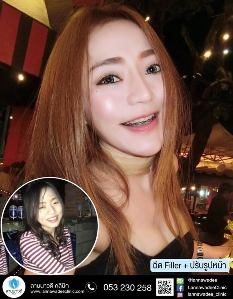 ฉีด Meso Fat เชียงใหม่