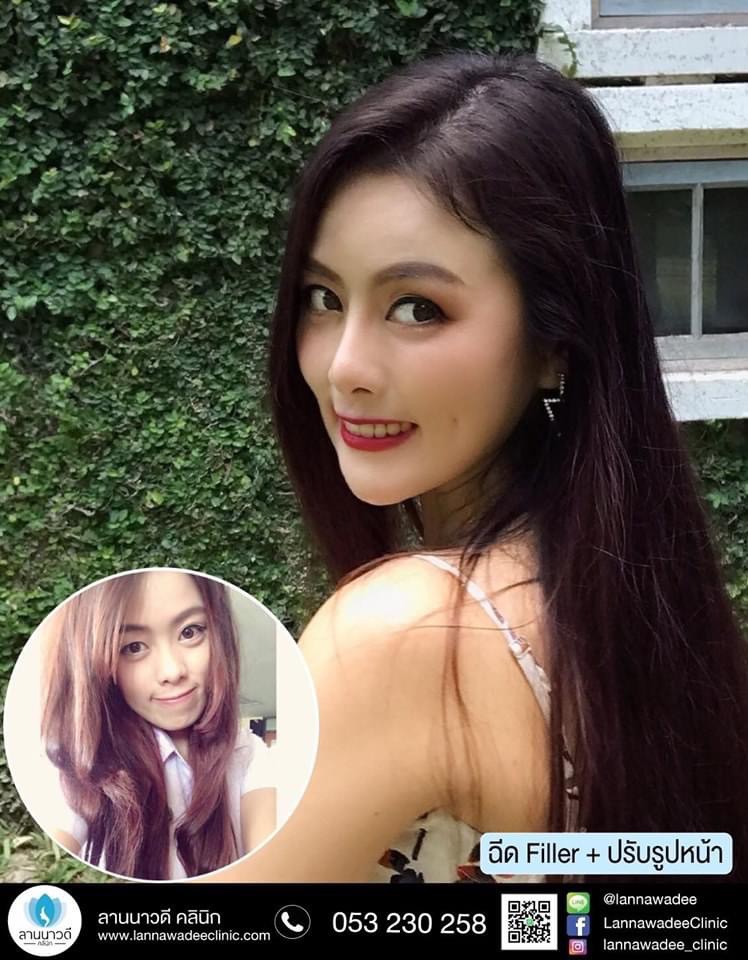 ฉีด Meso Fat เชียงใหม่