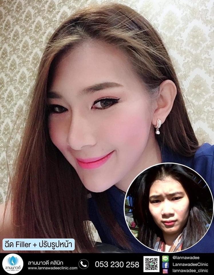 ฉีด Meso Fat เชียงใหม่