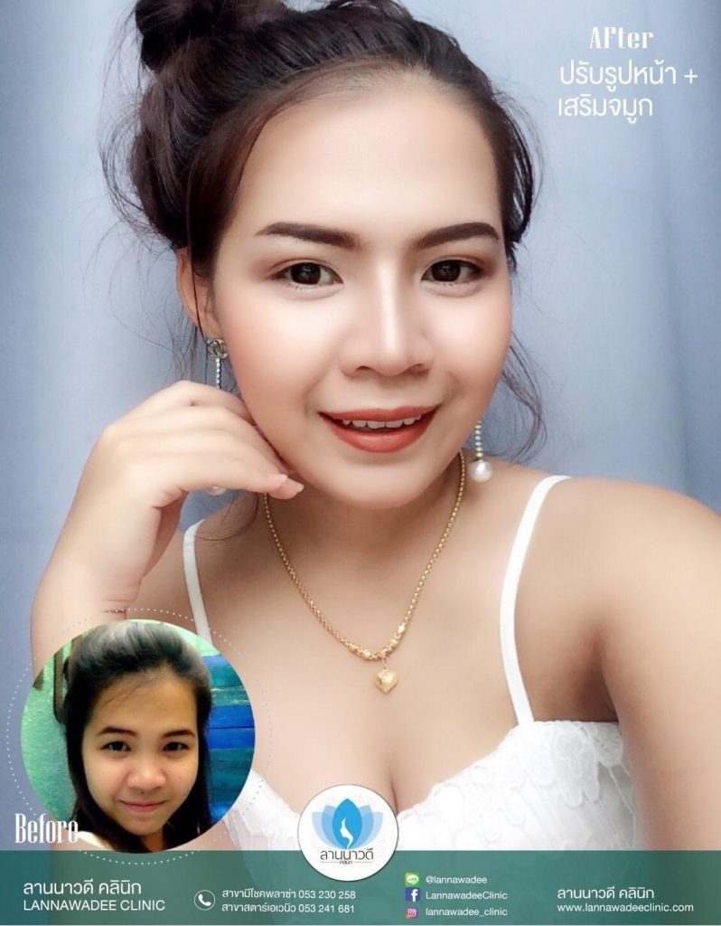 ฉีด Meso Fat เชียงใหม่