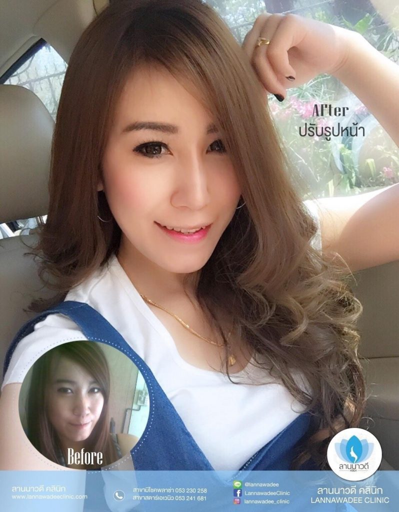 ฉีด Meso Fat เชียงใหม่