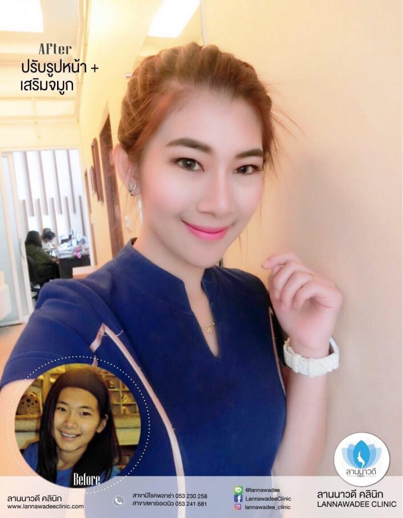 ฉีด Meso Fat เชียงใหม่