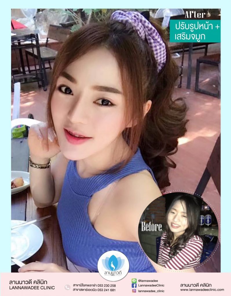 ฉีด Meso Fat เชียงใหม่