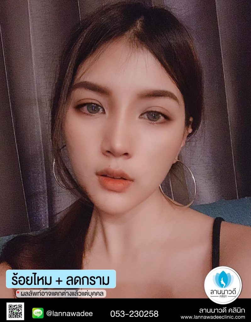 ฉีด Meso Fat เชียงใหม่