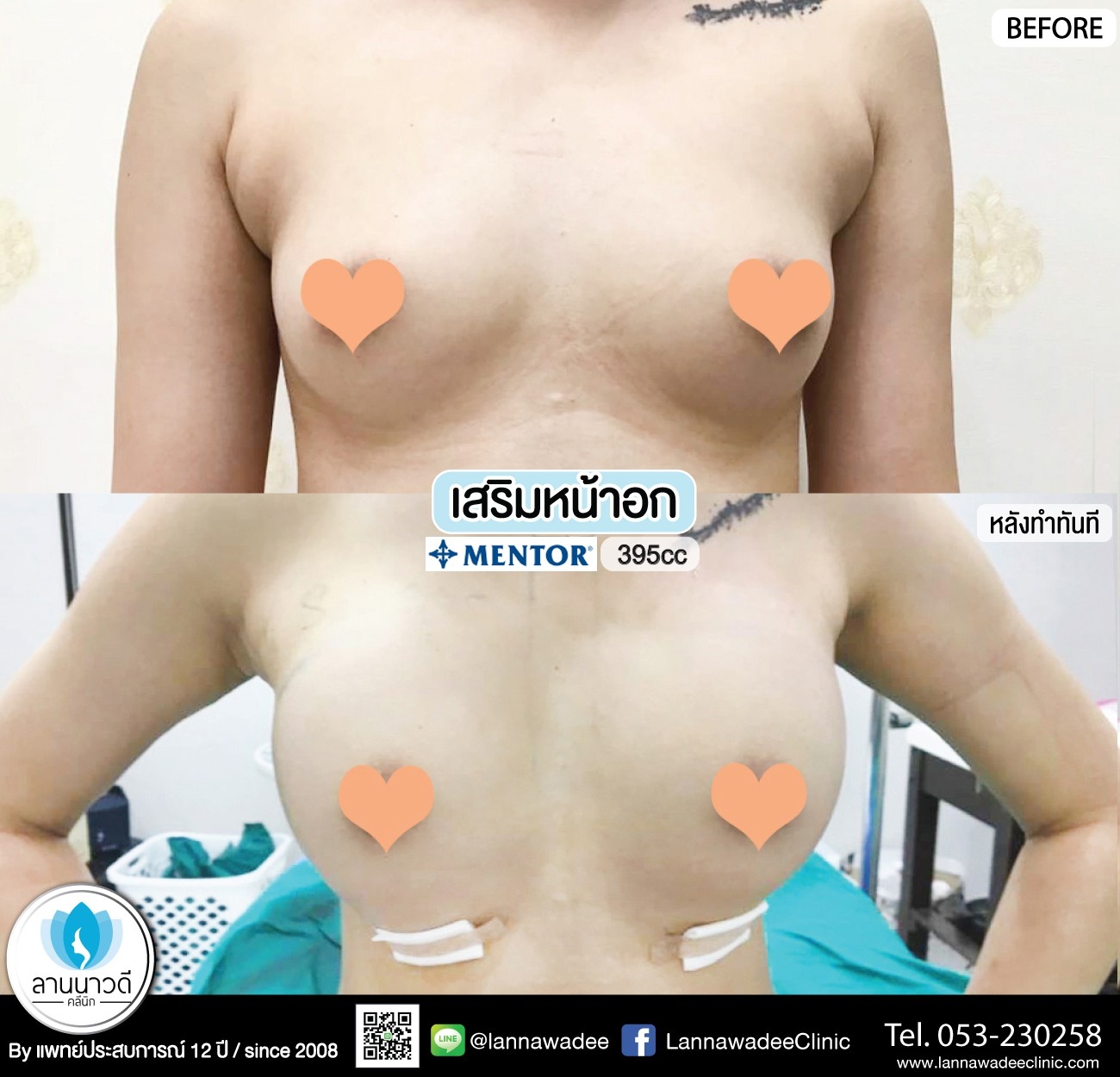 เสริมหน้าอกเชียงใหม่/