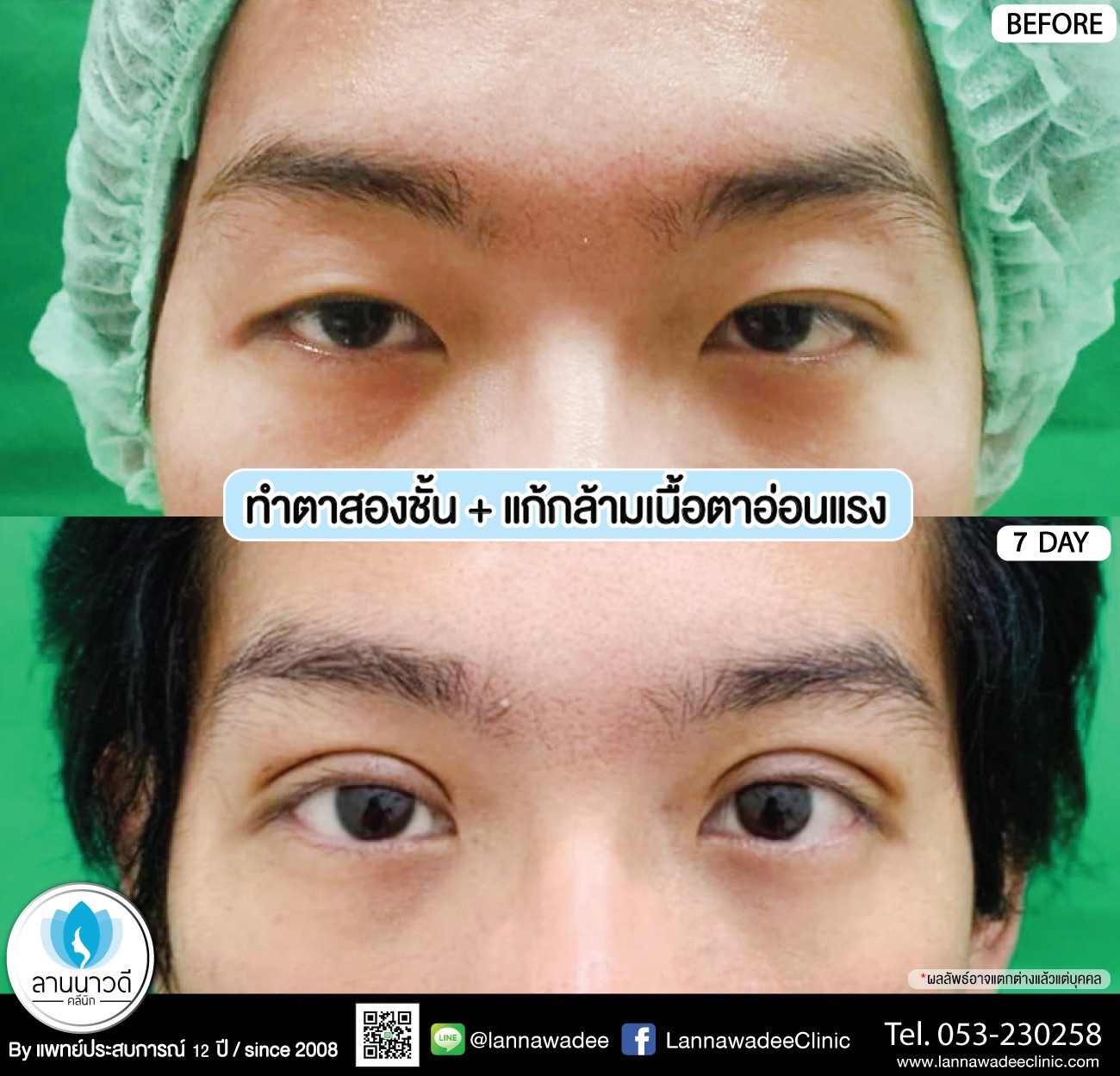 แก้หนังตาตก