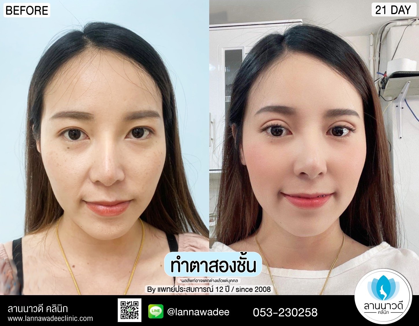 ศัลยกรรมตกแต่งตา
