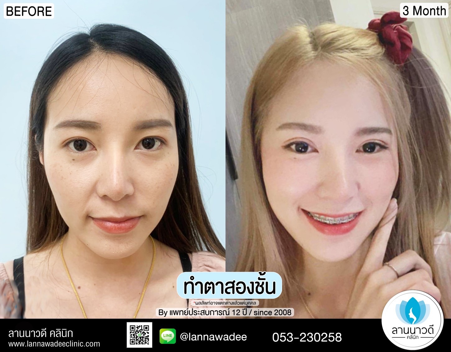 แก้หนังตาตก