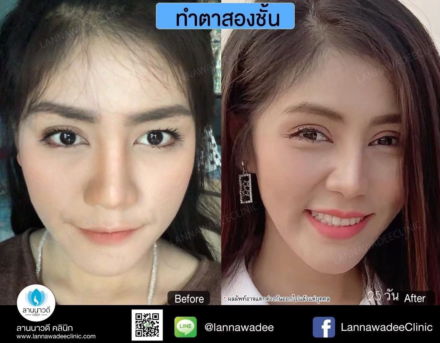 ศัลยกรรมตกแต่งตา