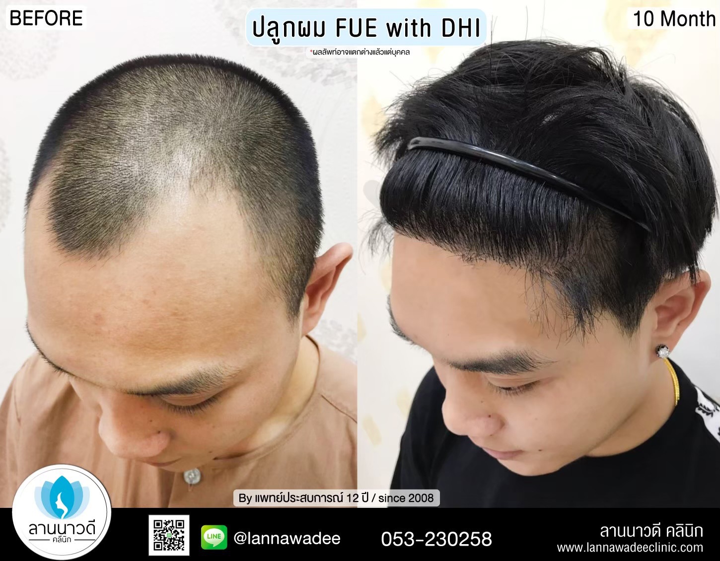 ปลูกผม