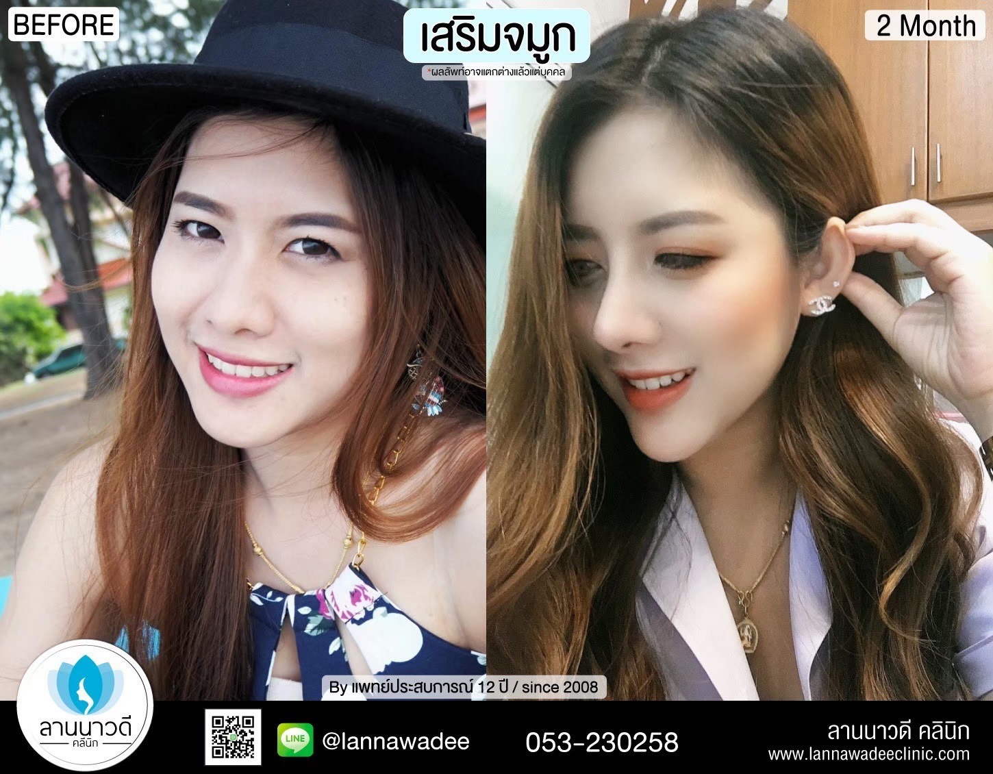 เสริมจมูก ที่ไหนดี2566