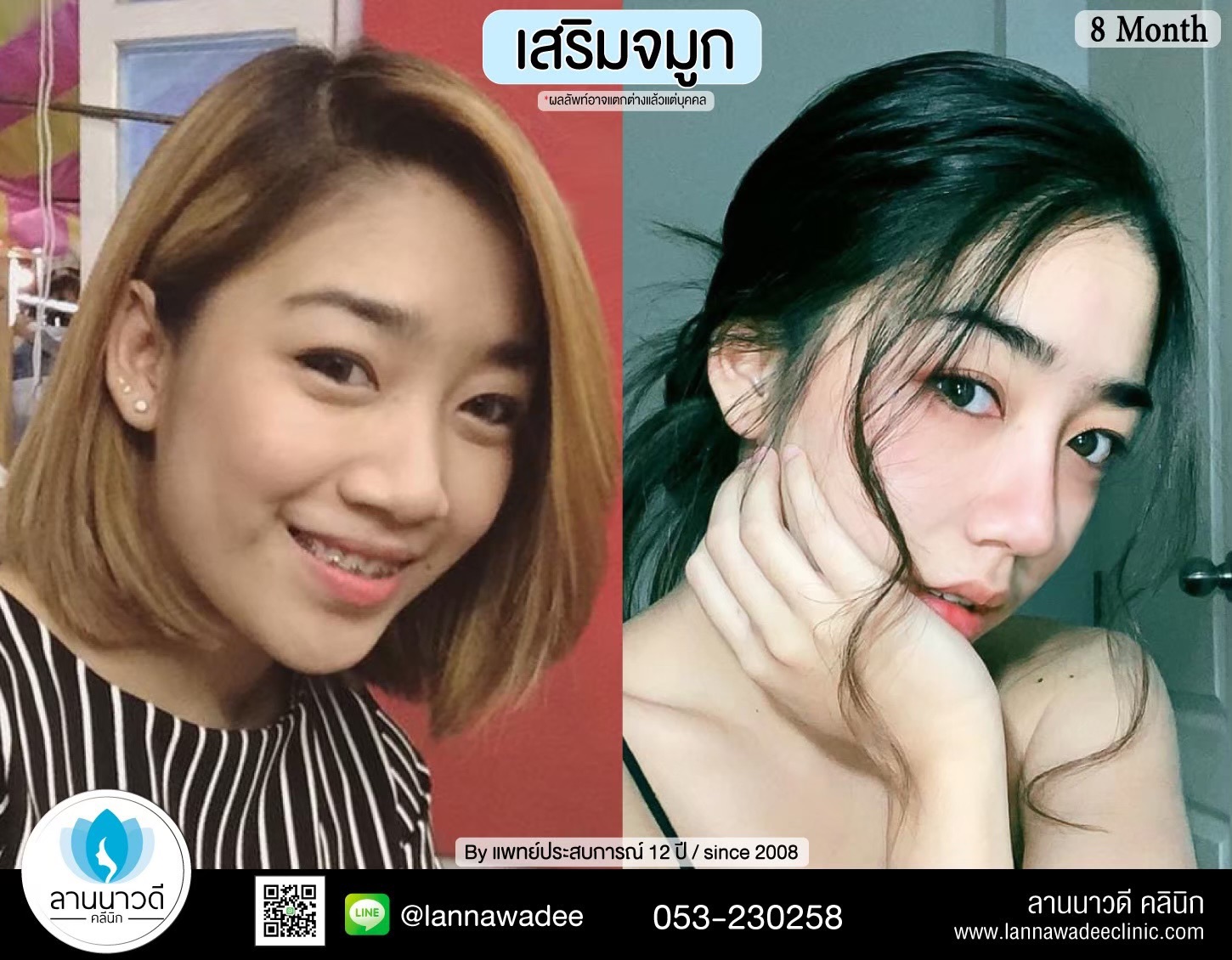 เสริมจมูก