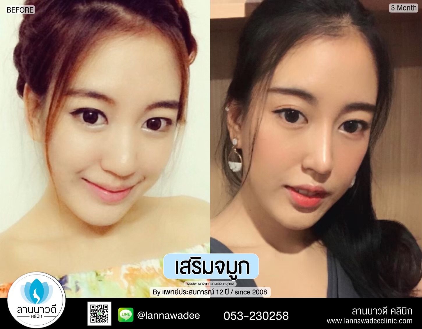เสริมจมูก