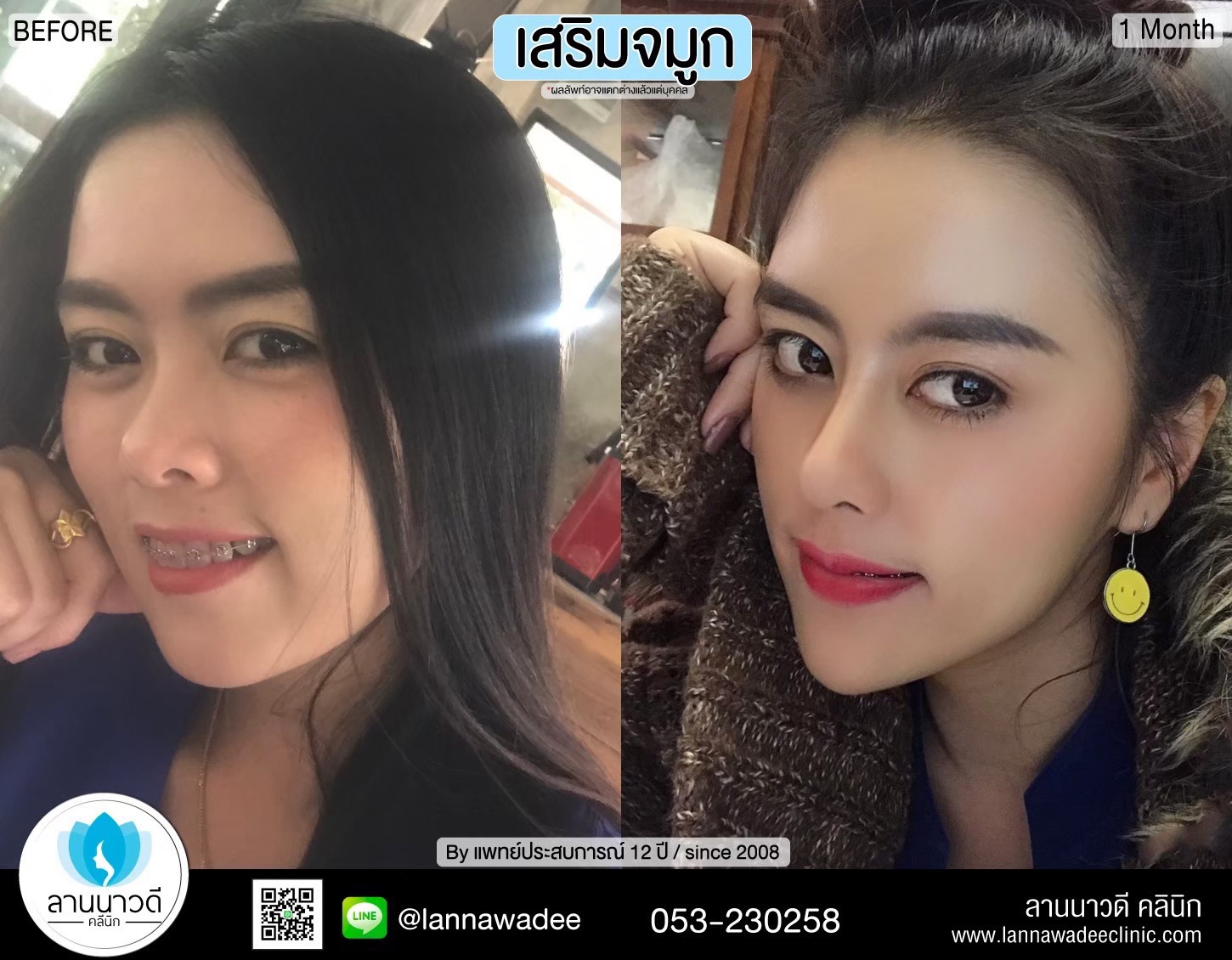 เสริมจมูก
