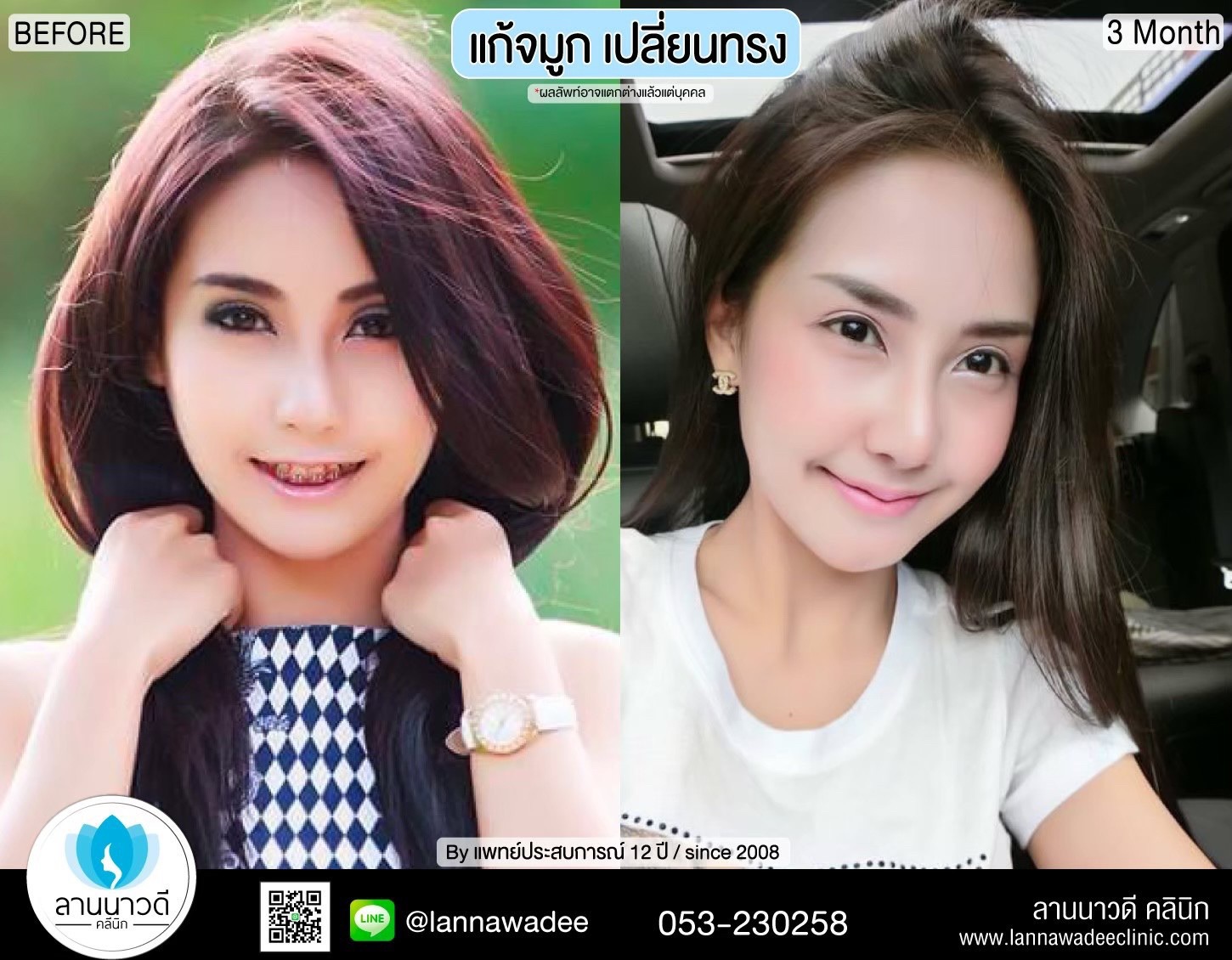 เสริมจมูก