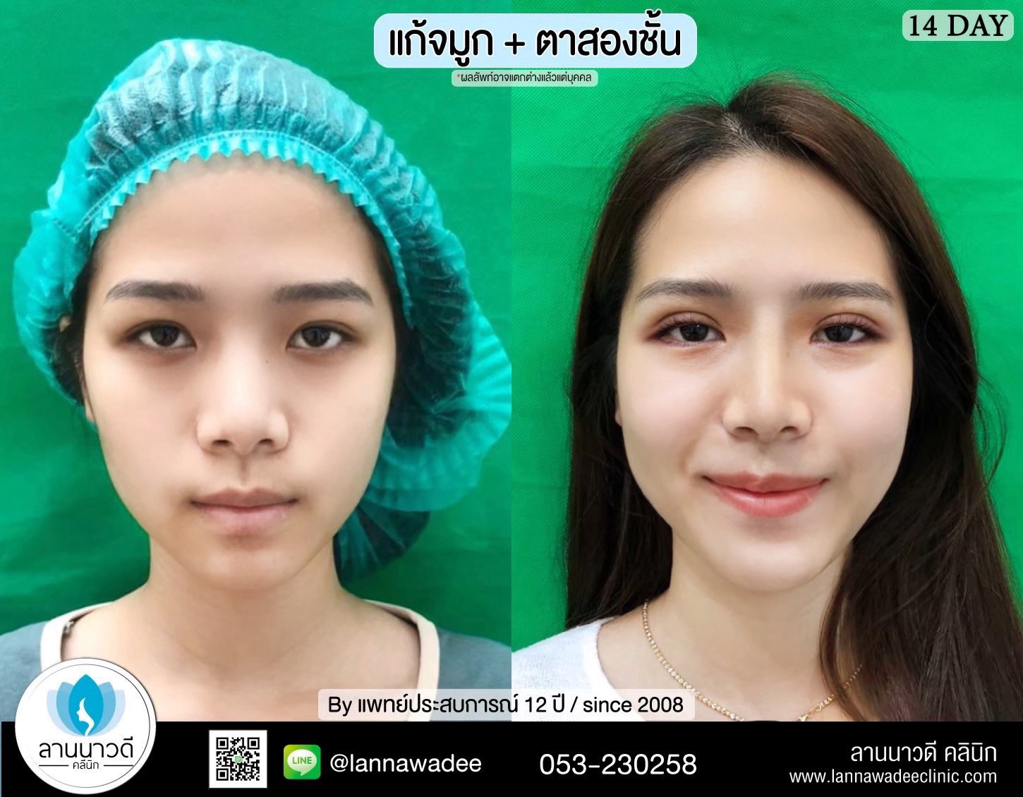 เสริมจมูก