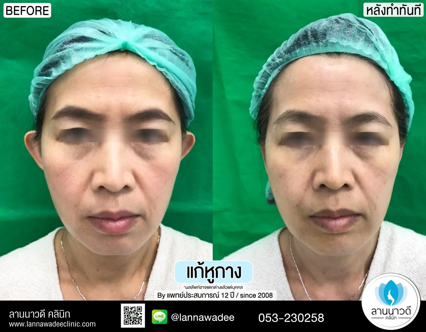 แก้หูกาง